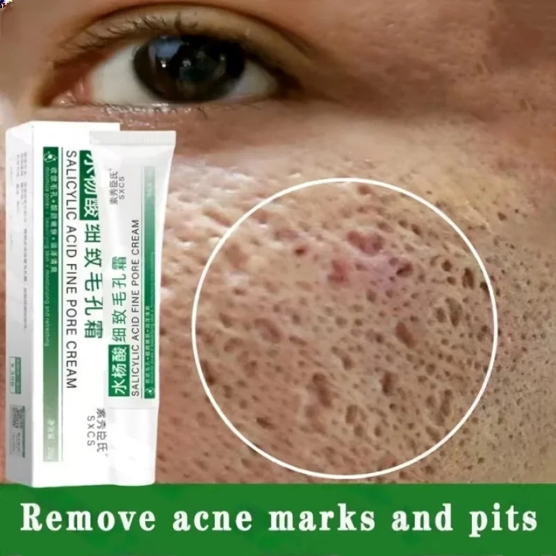 Salicylic Acid Blackhead Remover - Salicylzuur Porie Clearing Cream Krimpen Poriën